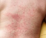 Dengue: por que o sétimo dia é considerado crucial para a doença?