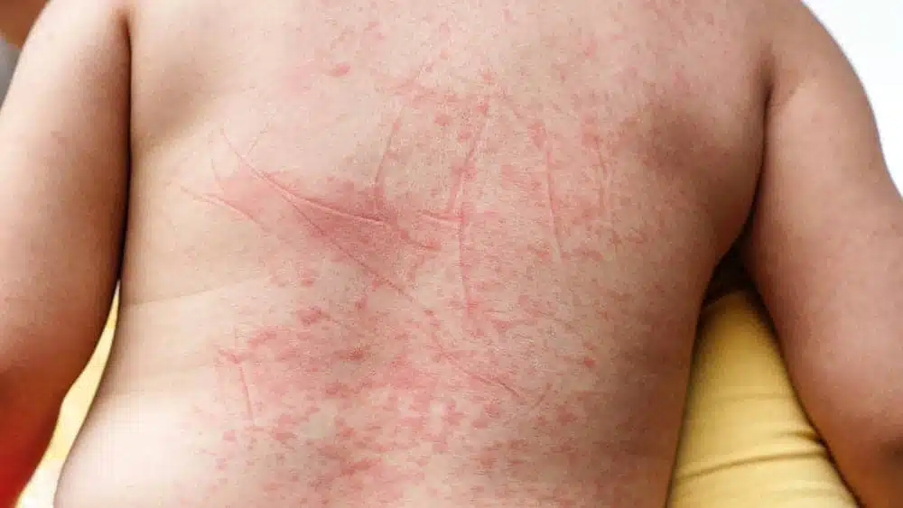 dengue