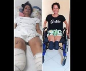 Foto de mulher na cama do hospital e na cadeira de rodas que teve os pés e dedos das mãos amputados e busca próteses