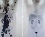 Paciente com câncer tem remissão completa após terapia inovadora testada