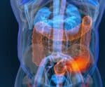 Câncer de intestino: veja 5 sinais de alerta