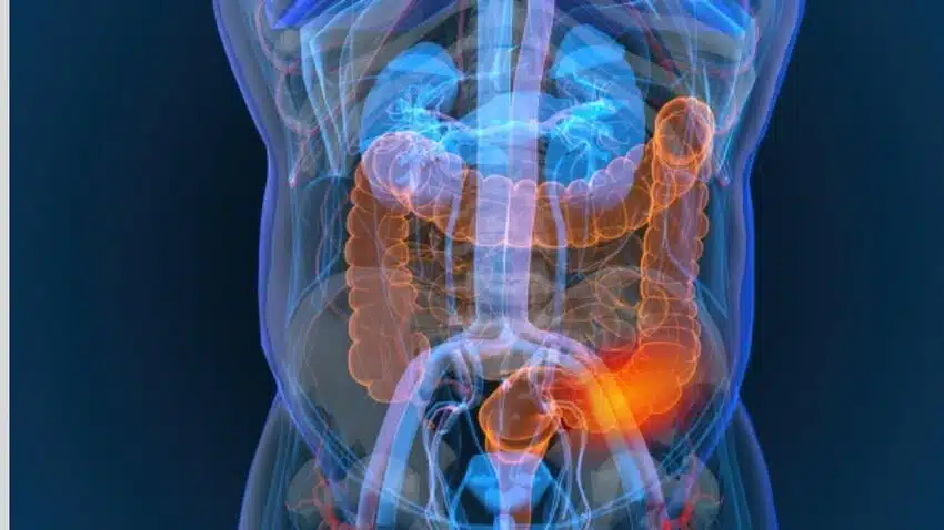 A foto apresenta intestino e possível câncer