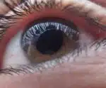 Glaucoma: milhões de brasileiros vivem sem diagnóstico