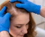 Alopecia: Veja como obter tratamento gratuito pela rede pública de saúde
