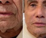 Harmonização facial: há limite de idade e quantidade de material aplicado?