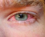 Conjutivite: no verão os cuidados com os olhos devem ser redobrados