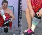 Mulher cria prótese de liquidificador após esperar por perna mecânica
