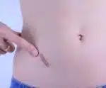 Braquiterapia é tratamento inovador para quelóide em Cachoeiro