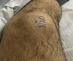Paciente escreve “sim” e “não” nos joelhos para evitar erro em cirurgia