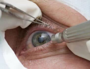 O que é catarata e por que a cirurgia feita por Lula é tão comum