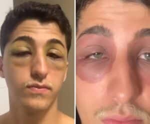 Barata morde? Empresário acorda com o rosto ‘irreconhecível’ e intriga web Barata morde?