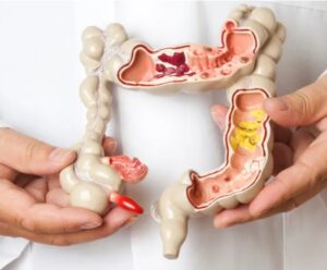 Câncer de intestino: ES abre campanha nacional de combate a doença