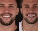 Arthur Picoli passa por procedimento para ‘consertar’ sorriso