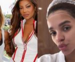 Brunna Gonçalves diminui o tamanho da testa com frontoplastia