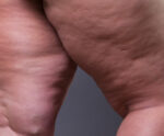 Lipedema: confira 3 dietas eficazes para tratar o problema