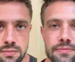 Rafael Cardoso mostra harmonização após sumiço nas redes sociais