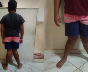 Ajude Thales! Criança precisa de cirurgia urgente em Cachoeiro Thales, cachoeirense