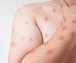 MPox: confira os sintomas e como se prevenir da doença
