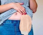 Colostomia: o que é, tipos, cuidados e qualidade de vida