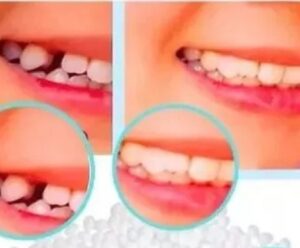 Dente da Shopee: não compre antes de ler essa informação Imagem ilustra dentes da shoppee