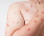 Mpox: saiba mais sobre essa grave doença que chegou ao sudeste!