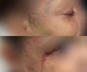Pai é suspeito de agredir violentamente filhos de 5 meses e de 1 ano crianças agredidas