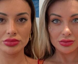 Andressa Urach muda a cor do olhos e reclama de dor: “Arrependida”