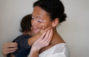 A foto mostra mãe com vitiligo