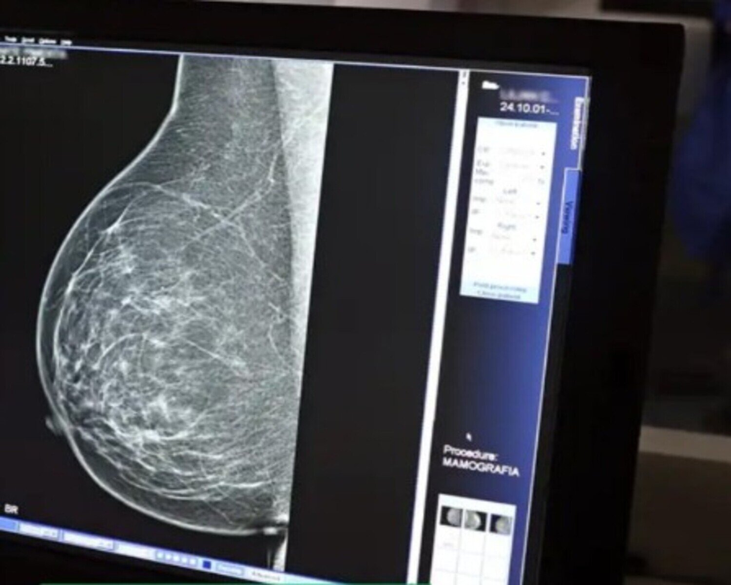 A foto mostra imagem da mamografia indolor