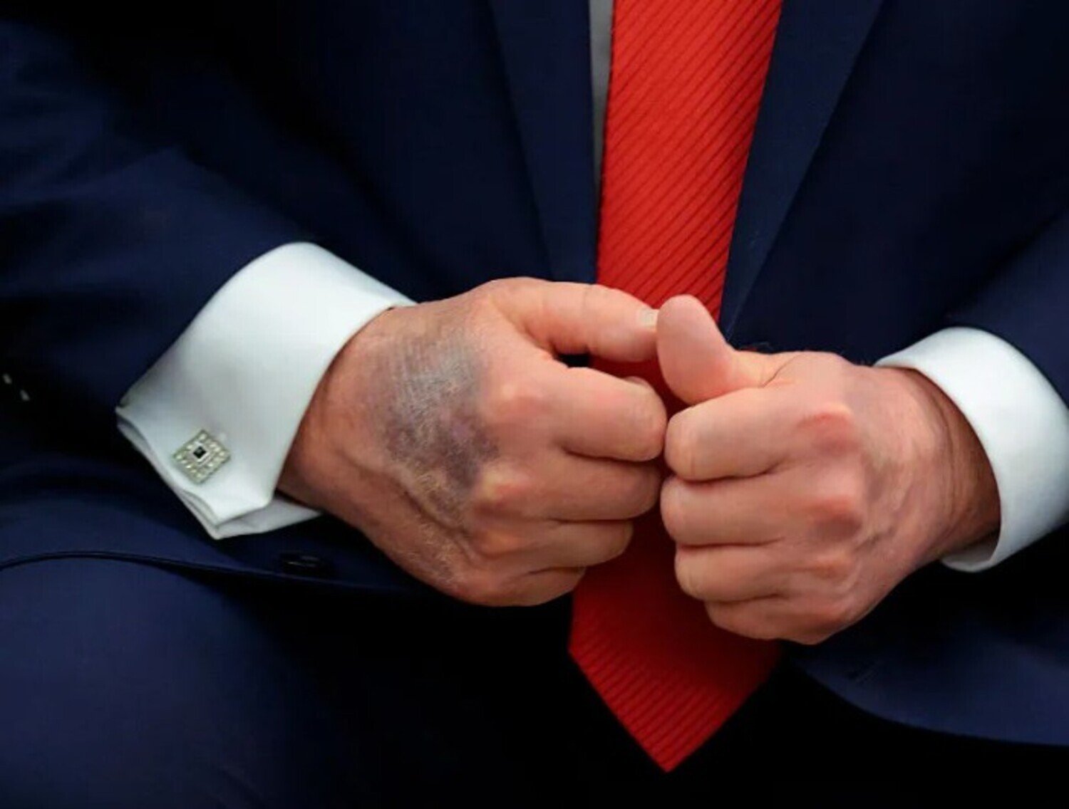 A foto mostra Trump com mancas na mão.