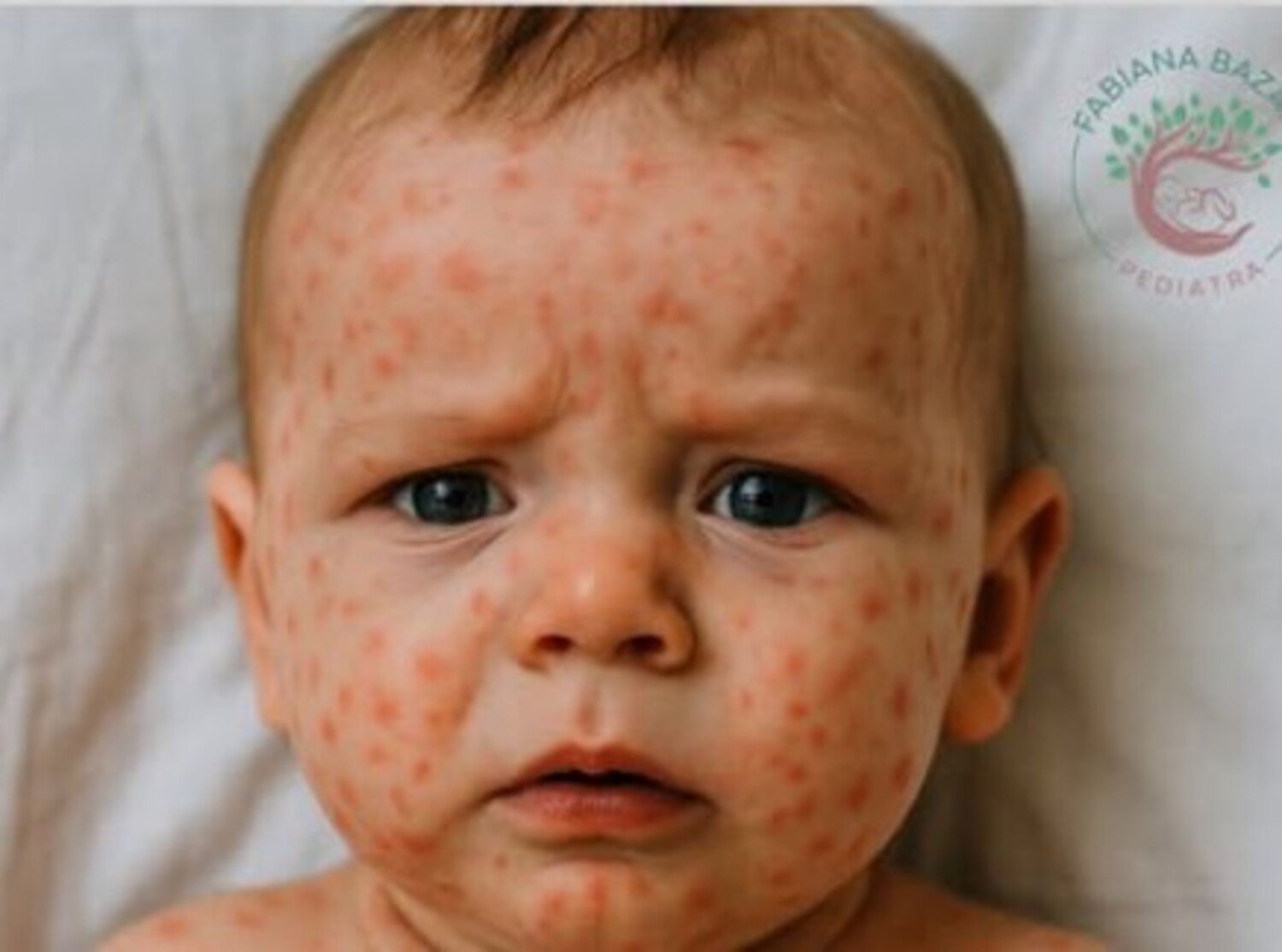 A foto mostra bebê com sarampo.