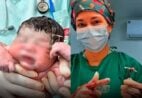 Bebê nasce saudável segurando DIU que falhou como contraceptivo – confira