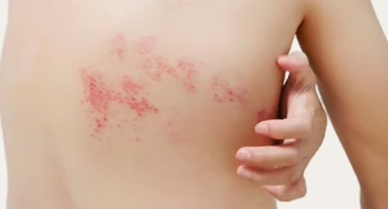 A foto mostra pessoa com herpes zoster