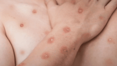 Nova mutação de mpox coloca mundo em alerta; entenda o risco