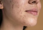 Acne é doença, não estética: quando usar isotretinoína pelo SUS
