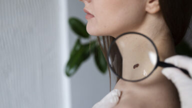 Mutirão de câncer de pele no sul do ES oferecerá consultas e cirurgias