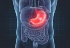 O que é H. pylori e por que você deve ficar atento