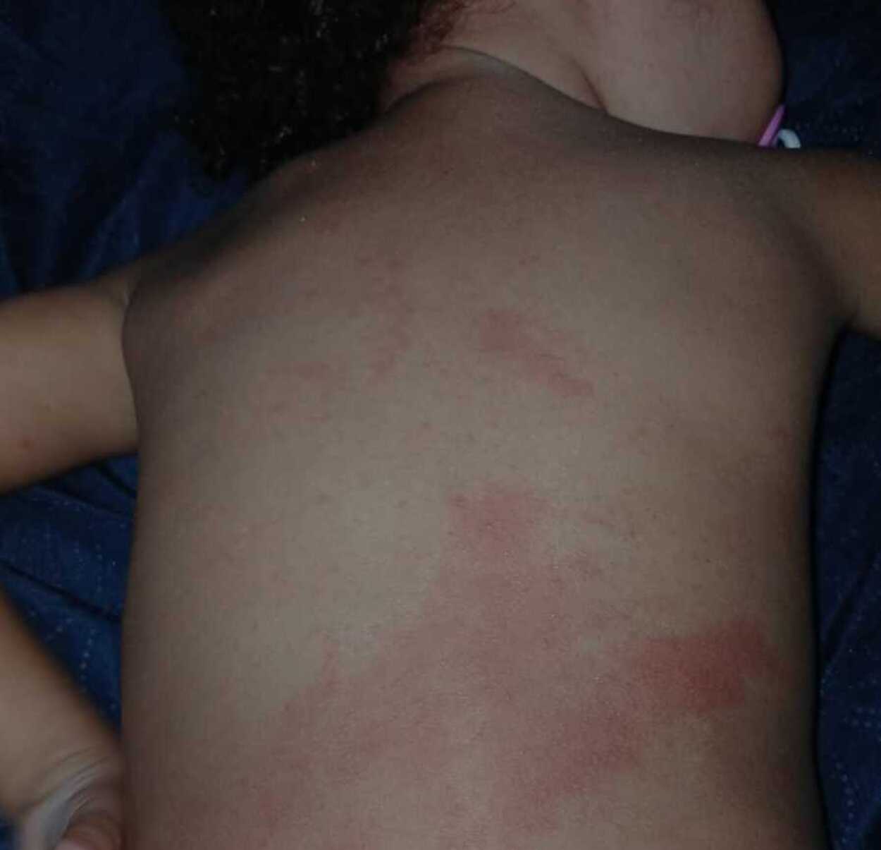 A foto mostra caso de roséola infantil