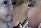 Você sabe que o frio pode causar reação alérgica e surpreender muita gente?