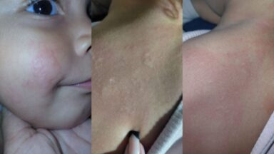 Você sabe que o frio pode causar reação alérgica e surpreender muita gente?