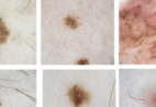 Esta pinta brava pode ser um melanoma: cuidado
