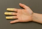 Doença de Raynaud: frio intenso pode revelar problema circulatório silencioso