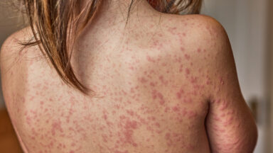 Casos de catapora aumentam em Guarapari e Saúde faz alerta à população