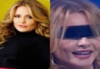 Blefaroplastia: quando complicações podem afetar a visão
