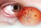 Retinopatia diabética: como o diabetes afeta a visão