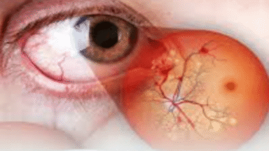 Retinopatia diabética: como o diabetes afeta a visão