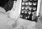 Endometriose cerebral? Pesquisas apontam possibilidades