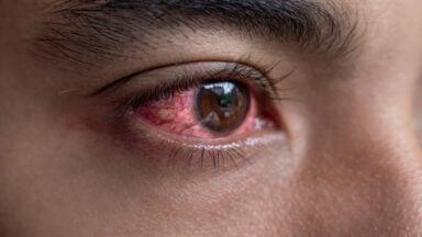Vermelhidão nos olhos: saiba como lidar com a conjuntivite